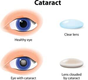 Illustration of a healthy eye lens and a cataract