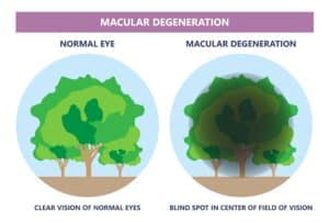 Image showing a tree seen through normal vision next to a blotted-out tree seen through an eye with advanced AMD Image showing a tree seen through normal vision next to a blotted-out tree seen through an eye with advanced AMD