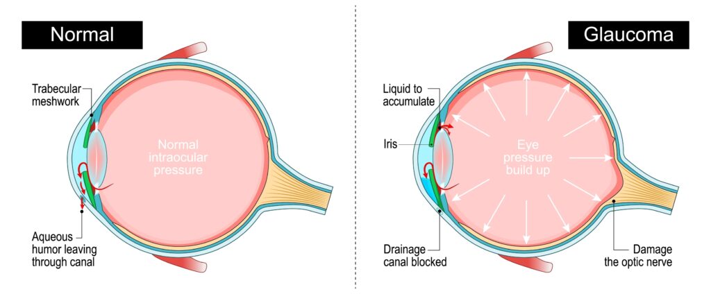 Brookfield man rubs his eye after experiencing symptoms of glaucoma Diagram showing a normal eye and one with glaucoma